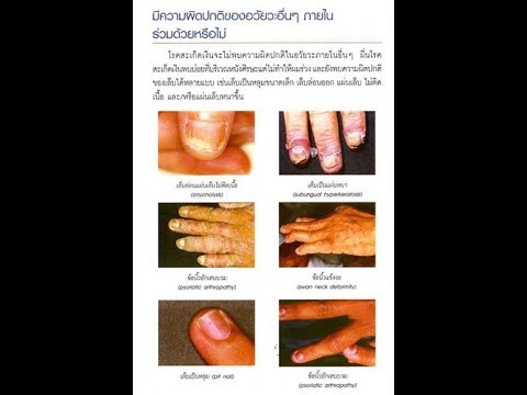 ครีมสำหรับโรคสะเก็ดเงินในการแก้ไขหัวพื้นบ้าน ที่ล้อมรอบด้วยกลาก