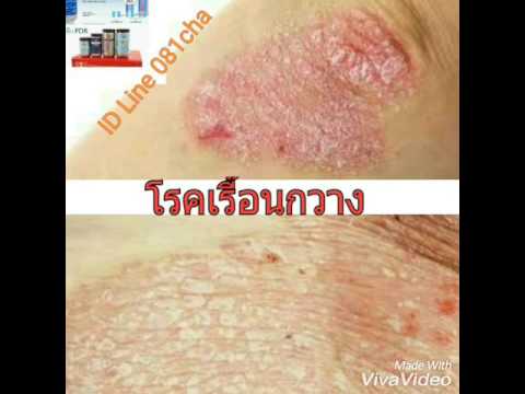 โรคสะเก็ดเงินเป็นผิว กลากรักษาอาหาร