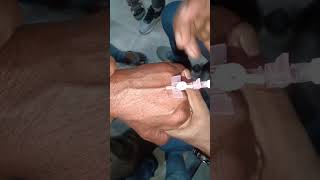 Cannulation video part 1019 #shorts #trending #viral #motivation
