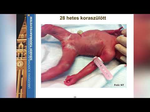 hogyan lehet férgeket hazahozni? levetkőzni parazita gyógyszereket