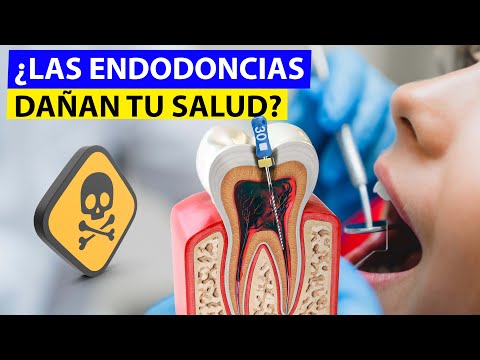 Las Endodoncias Bien Hechas Pueden Salvar Los Dientes