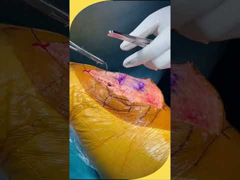 Stratafix: Advanced Suturing in Total Knee Replacement | Dr.Ranvijay Pathak