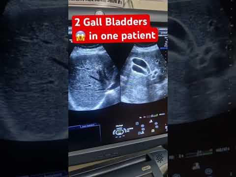 Rare case of 2 Gallbladders in 1 person? 😱 Rare Ultrasound Case You Won’t Believe!