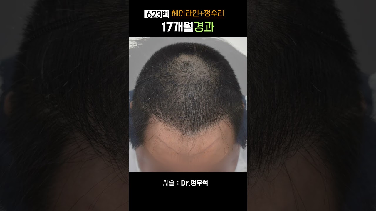 623번 헤어라인 + 정수리 비절개 5000모발이식  모바른 정우석 원장