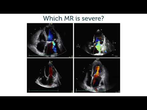 Which of these mitral regurgitations is severe?
