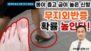 무지외반증