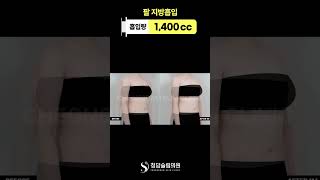 팔라인 미쳤다… 지방흡입 30일차 변화🔥