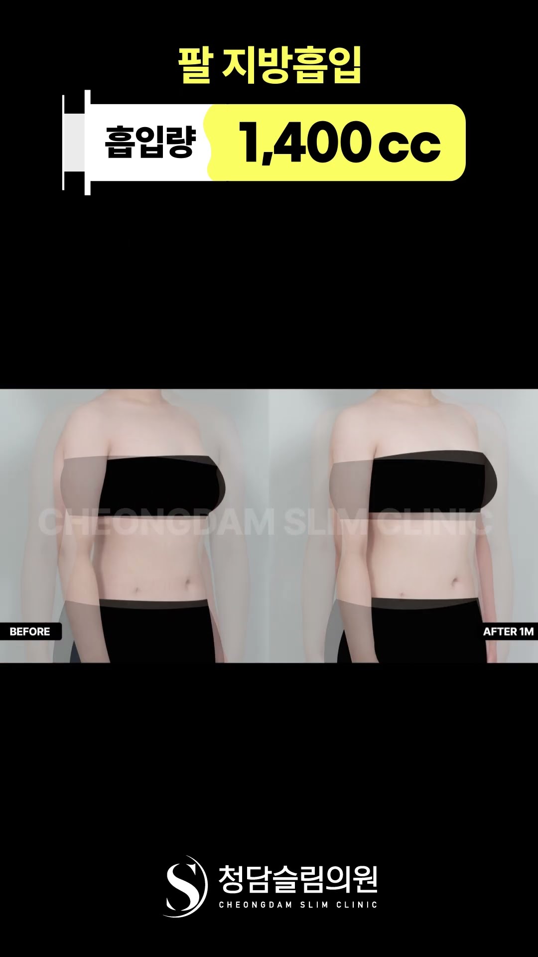 팔라인 미쳤다… 지방흡입 30일차 변화🔥