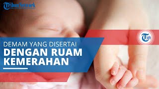Demam Scarlet, Penyakit yang Ditandai Timbulnya Ruam Kemerahan, Biasanya Diidap Anak Usia 5-15 tahun