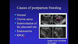 Retained Products of Conception Ultrasound Video Lecture