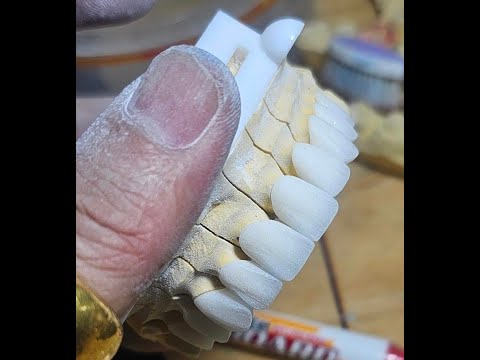 Gia công sườn sứ Star Ceram-Z tại Lab H Smile