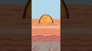 Download lagu 😬 Kenapa Jerawat Malah Tambah Banyak Setelah Dipencet? #Skincare #informatif #faktaunik mp3