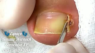 Tratamento de 7 dias.