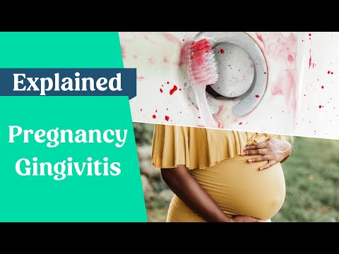 Pregnancy Gingivitis Explained