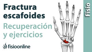 Fractura de ESCAFOIDES.  Rehabilitación, ejercicios y tiempo de recuperación