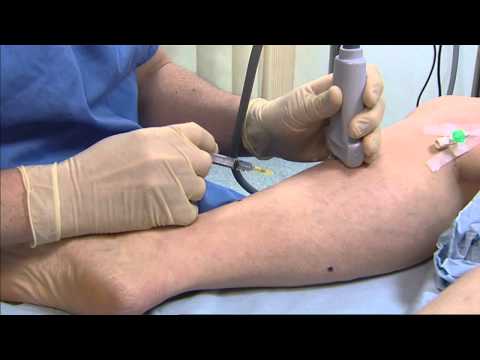 Foam sclerotherapy for varicose veins - Philip Coleridge Smith
