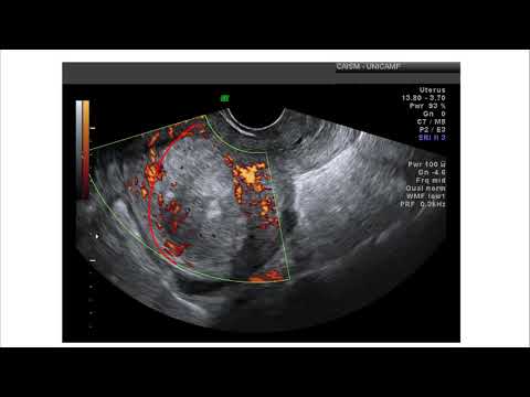 Papel da ultrassonografia transvaginal no rastreamento e no diagnóstico do câncer de endométrio
