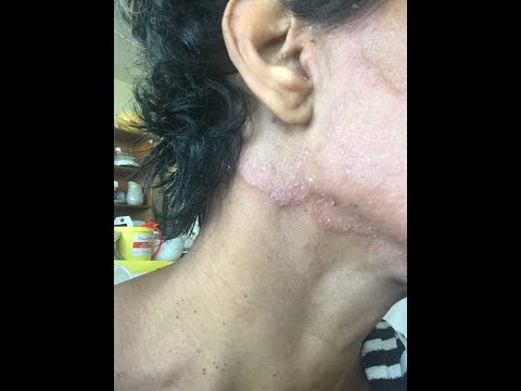 Cura di psoriasi principale da oli essenziali Cura della pelle del bambino a psoriasi