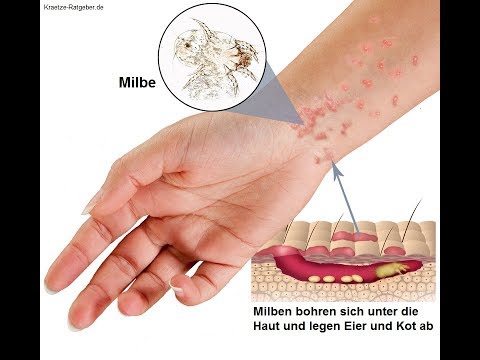 Schmerzen in den Kniegelenken Volksmedizin Hängen an der Bar mit zervikaler Osteochondrose
