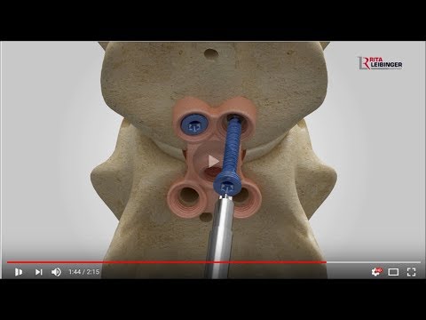 C-LOX - Spinal Surgery in Dogs - Disk Replacement - Wobbler Syndrome