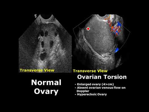 Ovary Ultrasound Normal Vs Abnormal Image Appearances | Ovarian Pathologies On USG