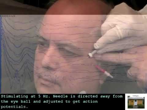 SFEMG - Stimulation Orb Oculi  (Joze Trontelj)