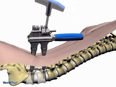 Behandlung von Knie-Arthritis Verursacht Schmerzen in auf dem rechten unteren Rücken