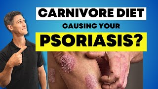 Psoriasis Diet Treatment: Carnivore diet made psoriasis worse!