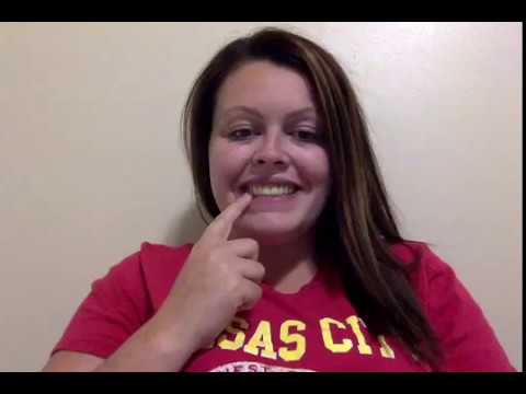 *Dentures at a young age update* 2 weeks post surgery!