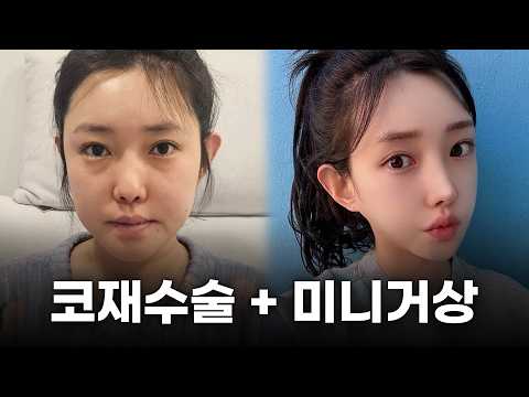 코끝처짐재수술부터 이중턱·미니거상까지, 5개월 변화 후기ㅣ디에이성형외과ㅣ30대성형후기브이로그