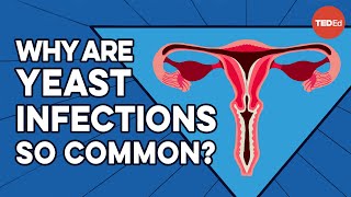 What causes yeast infections and how do you get ri