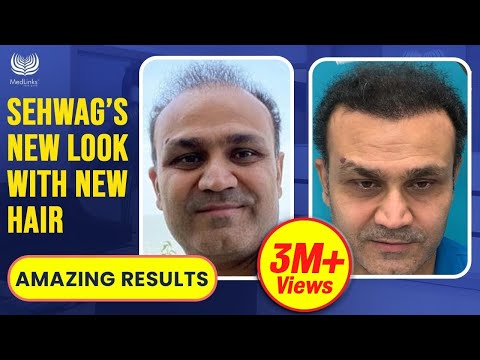 Virender Sehwag's Hair Transplant Results | Cricketer/Celebrity Hair Transplant In India