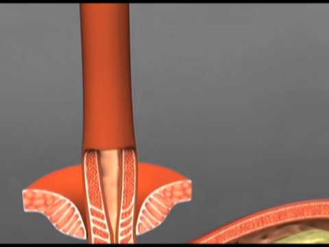 Linx Surgery for Reflux Disease