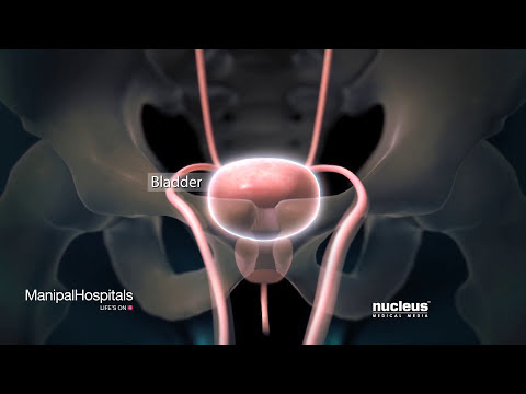 Robotic Cystectomy 