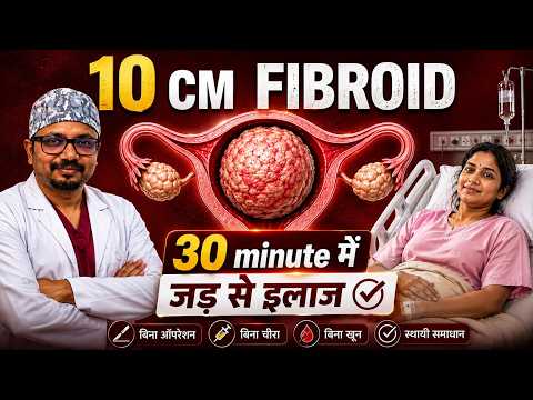10cm बच्चेदानी की गांठ का बिना ऑपरेशन इलाज: लाइव UFE प्रक्रिया