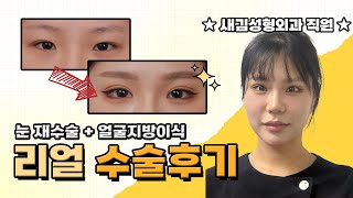 '출근길에 수술한 사람의 결말… 보여드립니다😋'직원이 직접 수술 받은 후기 (눈 재수술, 얼굴지방이식)