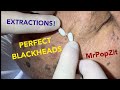 Extractions Of Thick Dried Out Blackheads On The Face Keratin Plugs Removed Cotton Tips Win Again