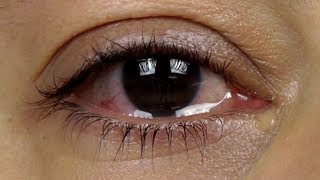 How to stop watery eyes? - Dr. Sunita Rana Agarwal
