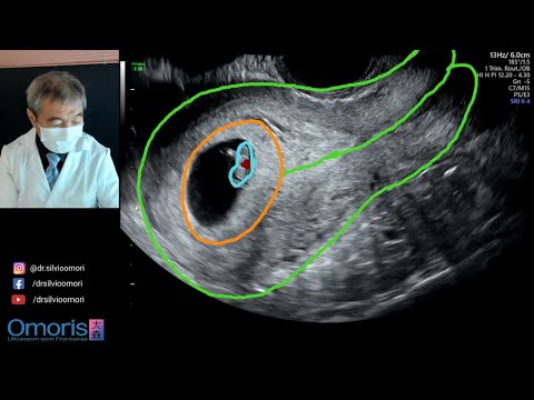 Gestação inicial - 7 semanas