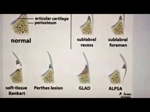 Shoulder Instability 2