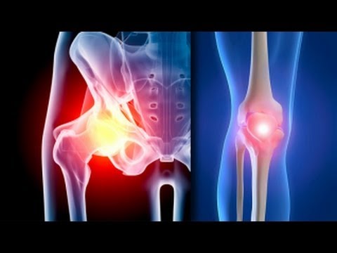 Tratament pentru artritele pastile de genunchi