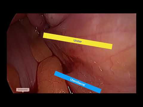 NOTES-Technik während laparoskopischer Kolpopexie