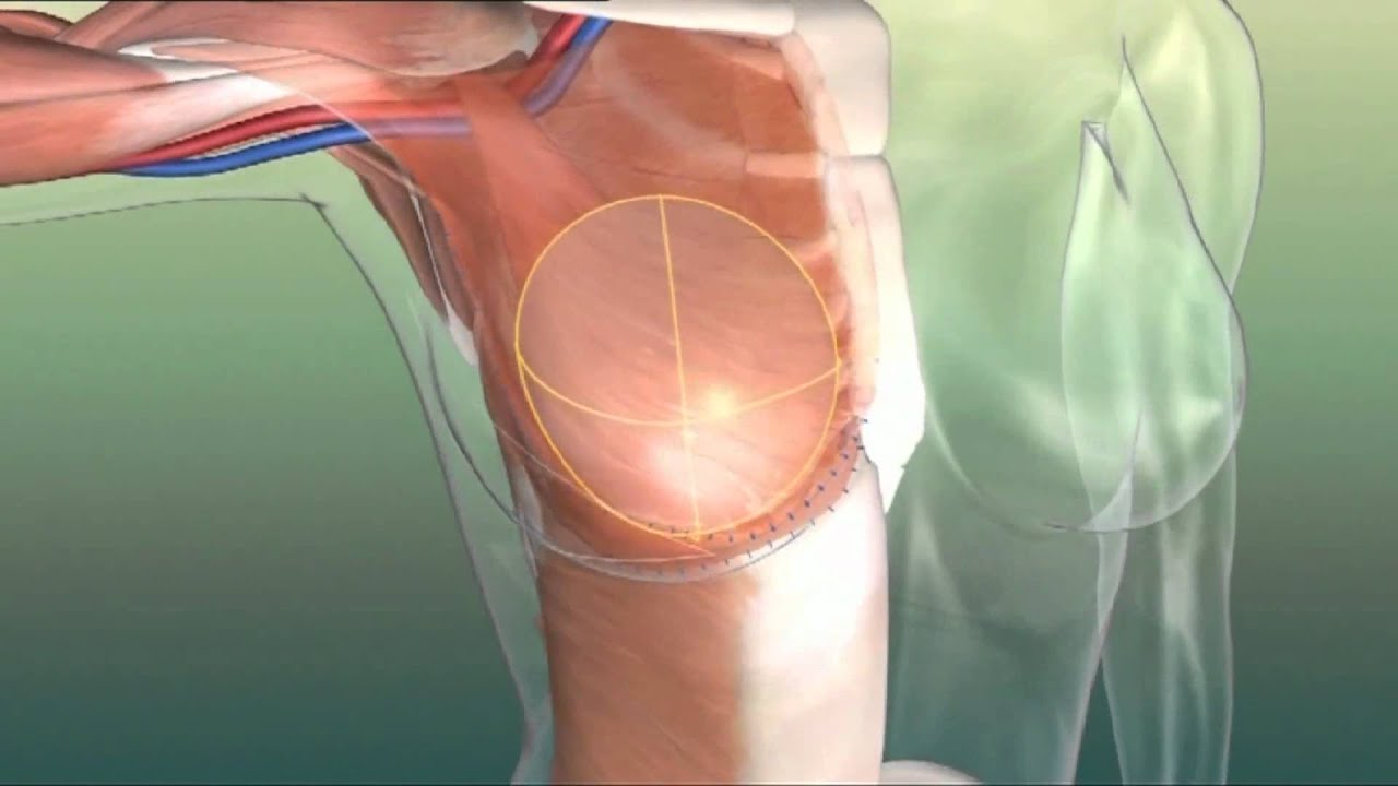 Brustrekonstruktion / Brustaufbau nach Brustkrebs info Medizin