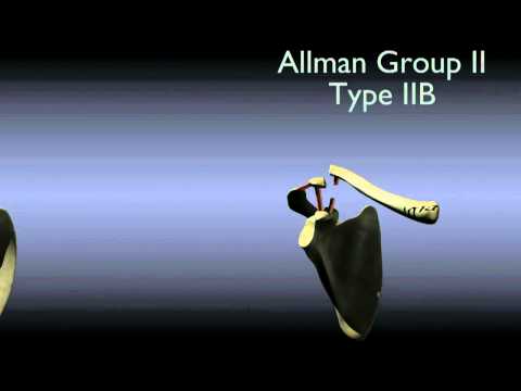 Classification of Clavicle Fractures