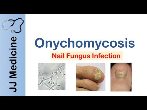 Schistosomiasis Bilharziasis Causes Symptoms and Treatment