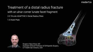 Intramedullary Nail Fixation Metacarpal