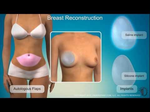 Na czym polega rekonstrukcja piersi?