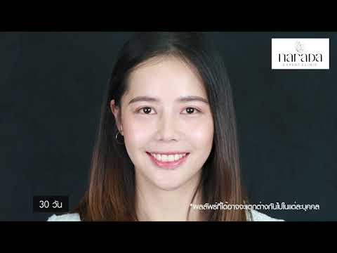 รีวิวเสริมจมูก รองเนื้อเยื่อเทียม ที่ นารดาคลินิก คลินิกความงามเชียงใหม่ รีวิวเสริมจมูก รองเนื้อเยื่อเทียม ที่ นารดาคลินิก คลินิกความงามเชียงใหม่