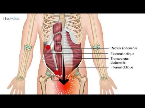Oblique Muscles - Trigger Point Anatomy
