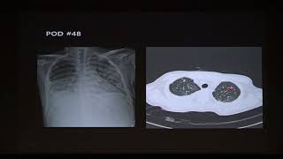 3rd AMC Surgical Critical Care Symposium  : Opportunistic Infection 미리보기